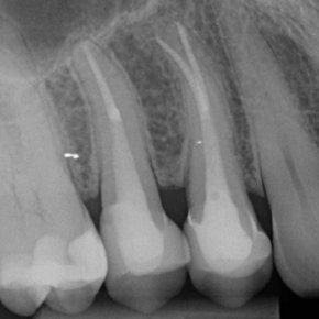 Opakované ošetření kořenových kanálků horních premolárů a zhotovení nových celokeramických korunek.