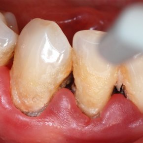 Úvodní fáze léčby parodontitidy - instruktáž, motivace, odstranění zubního kamene.