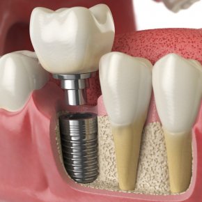 Zubní implantát.